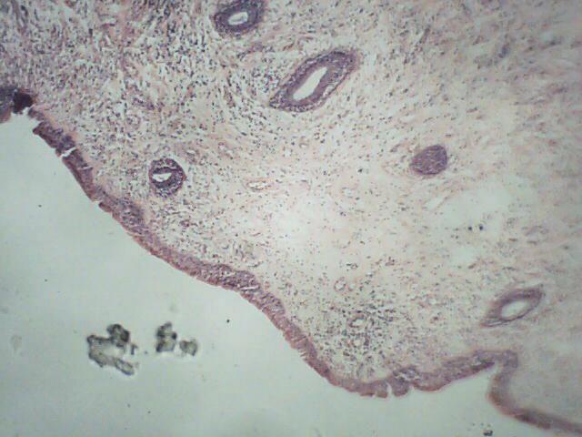Fig. 1: Simple nasal polyp.