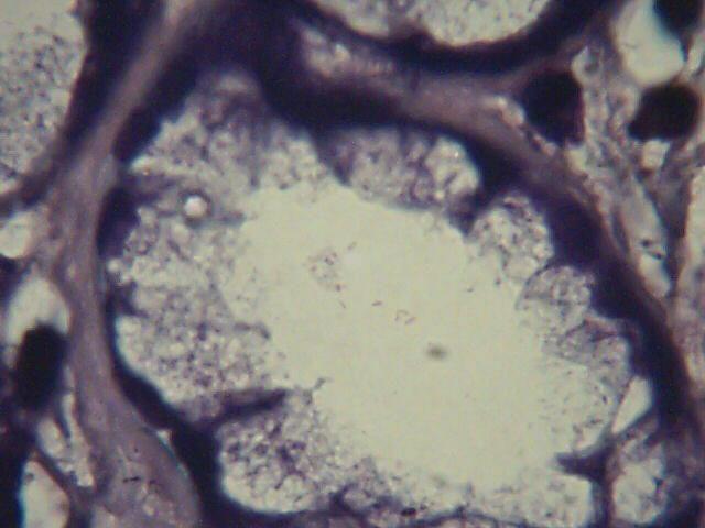 3 &4 : Section of mucous secreting gland within nasal polyp