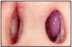 Important signs of allergic rhinitis on physical examination Face - signs of allergic rhinitis include: Darkened circles around