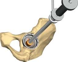 Acetabular shell insertion Select the appropriate acetabular implant, attach the shell to the cup positioner/impactor and insert it into the acetabulum.