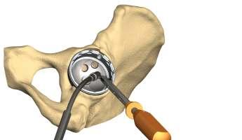 Acetabular screw insertion Screw ixation is simple, fast and the most common method of assuring additional ixation.