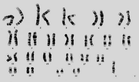 Turner Syndrome An individual inherits only a single X chromosome, as well the Y chromosome