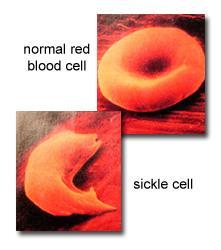 Co-dominant Inheritance Sickle-cell Anemia Best example of a codominant disorder Symptoms Defect in the hemoglobin and the red blood cells