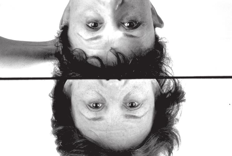 Fifty-six-year-old woman with bilateral brow ptosis and ageing; Bottom left Postoperative result through an upper lid