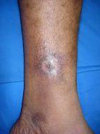 o Chronic ulcer at posterior side of ankle region (achilles) 3 Male 28 y.