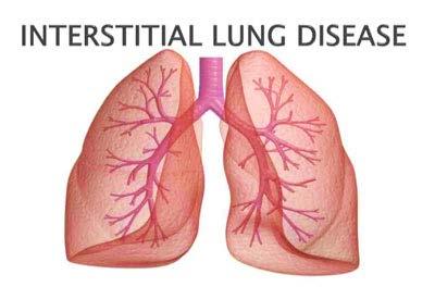 Interstitial Pulmonary Disease Interstitial Lung Disease (ILD) is a broad term that covers over 100 individual disorders.