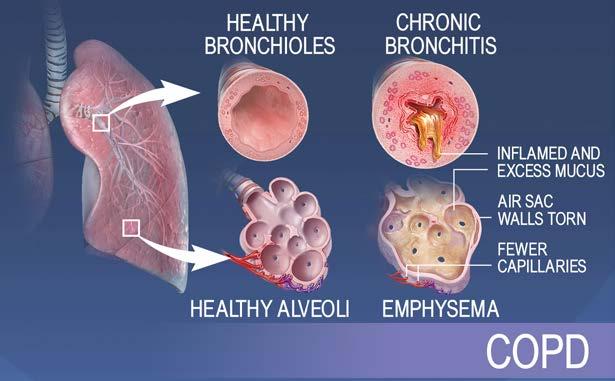 Emphysema Emphysema is specified as: Unilateral Pulmonary Emphysema J43.0 Panlobular Emphysema J43.1 Centrilobular Emphysema J43.