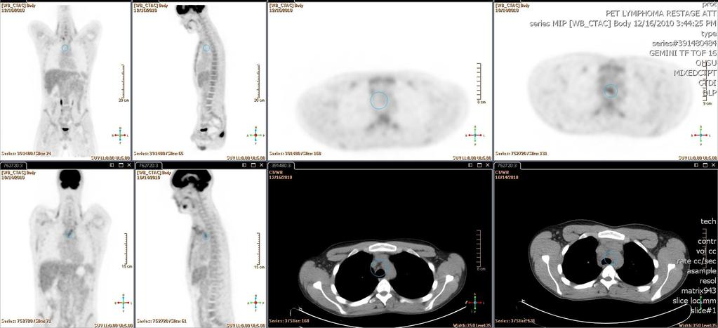 PET CT 12/16/10 CT scan on 12/9/10: Anteromediastinal residual lymphoma and is nodular conglomerate currently measures 1.8 x 1.1 x3.0 cm. Previous measurements were 2.