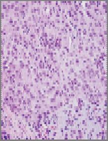 e TTF-1 +; p40 -): Non-small cell carcinoma, favor adenocarcinoma Morphologic squamous cell patterns clearly present: Squamous cell carcinoma Morphologic