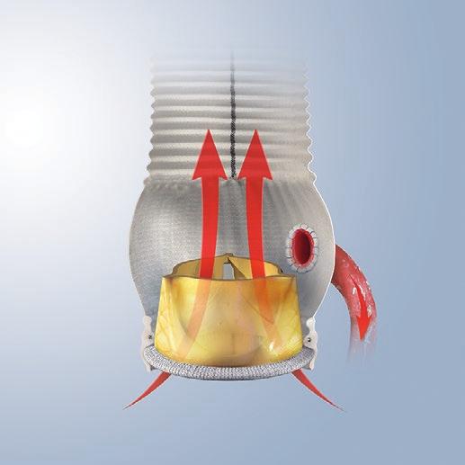 TM LIVANOVA S INNOVATIVE IS DESIGNED TO: Provide a reproducible and easy solution for better patients results Take advantage of the Mitroflow proven hemodynamic and clinical results