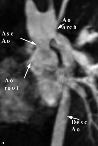 Post-operative follow-up z 109 z Potential complications Residual pressure gradient at the level of the aortic arch anastomosis and/or at the left ventricular outflow tract, residual ventricular