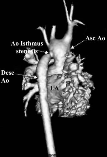 If a direct anastomosis is performed without adequate mobilization of the ascending and descending aorta, a bowstring effect over the left main bronchus may result.