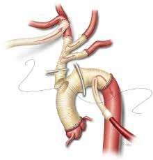 Conventional Open repair of Aortic Arch aneurysms Associated with significant perioperative morbidity and