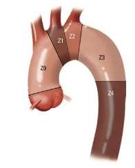 Endovascular Aortic Arch Repair Challenges of the aortic