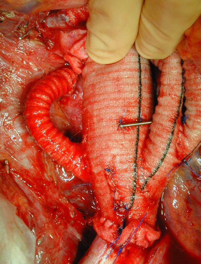 Infrarenal Aortic Replacement as Part