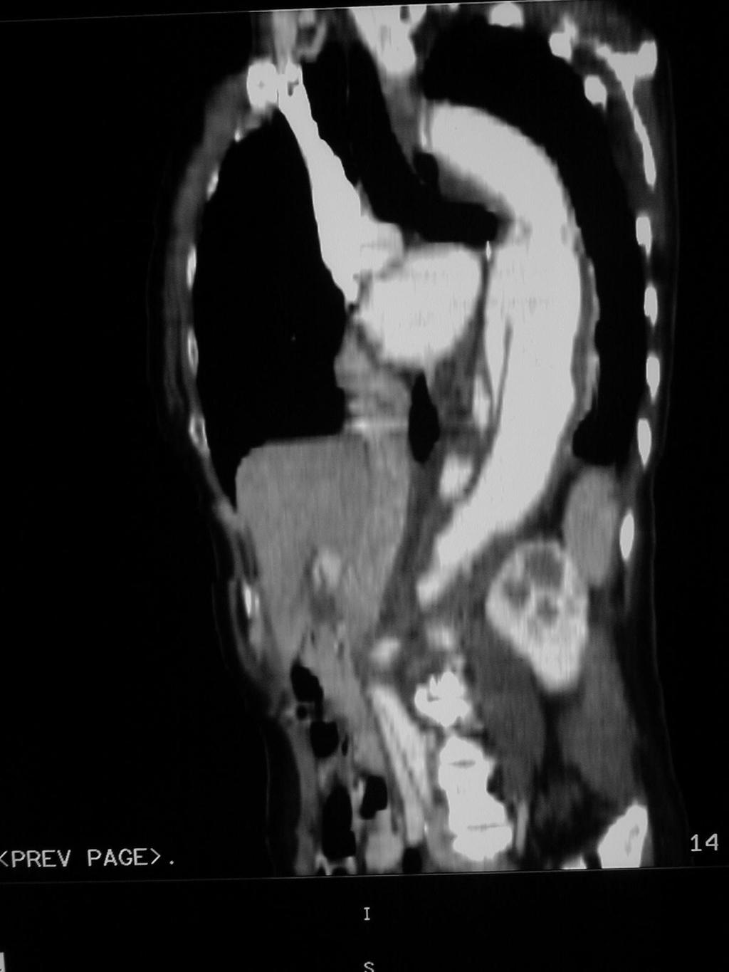 51 y/o woman Known Type B aortic dissection s/p left