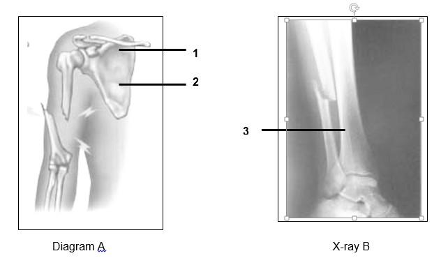 Question 2 Study the diagram (A) and the X-ray (B) (of the leg) and answer the questions that follow. 2.1 Name the bones labeled 1, 2 and 3. (3) 2.2 Name the bone that is broken in: a.) diagram A; b.