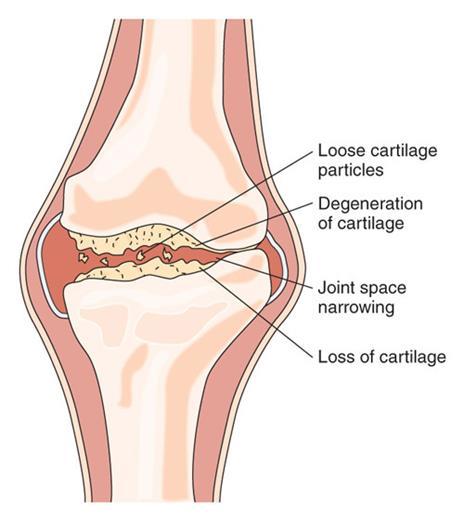 ARTHRITIS: ARTHR/O=JOINT ITIS=INFLAMMATION Signs and symptoms may include: Pain, Stiffness, Swelling, Redness, and Decreased range of motion Osteoarthritis OSTEO=JOINT