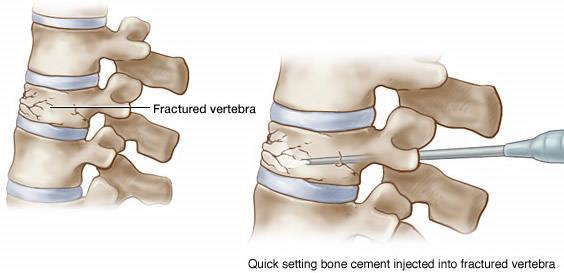 injected bone cement into the vertebral bodies to increase height, also this reduces pain from the bone grinding together.
