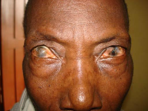 Ocular Pathology Ghana is a tropical country and its patients suffer from eye