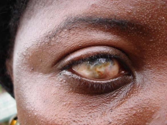Eye Diseases Examples of common ocular pathology in Ghana include: Glaucoma Trachoma Xerophthalmia and nutritional