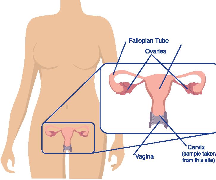 What is a Pap smear? A Pap smear is a simple procedure in which cells are removed from the lower end of the womb (cervix) during an internal examination of the vagina.