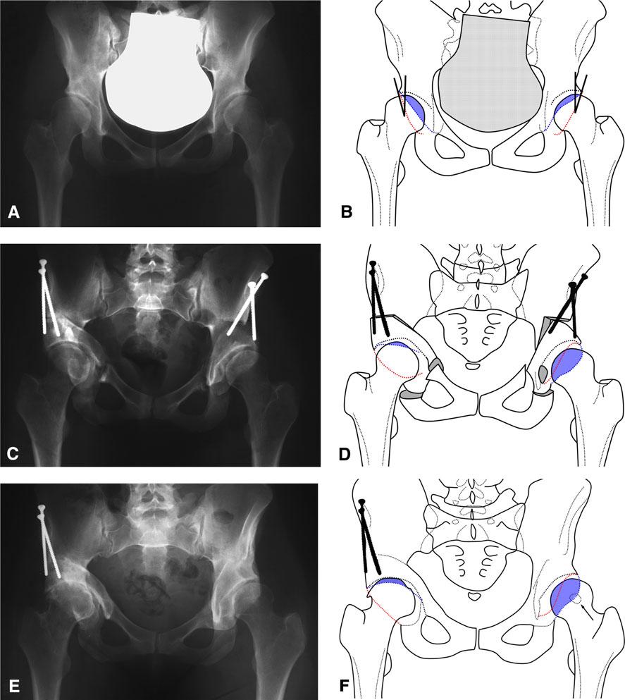 1612 Albers et al. Clinical Orthopaedics and Related Research 1 Fig. 5A F (A) A 32-year-old woman from Group II presented with bilateral hip dysplasia.