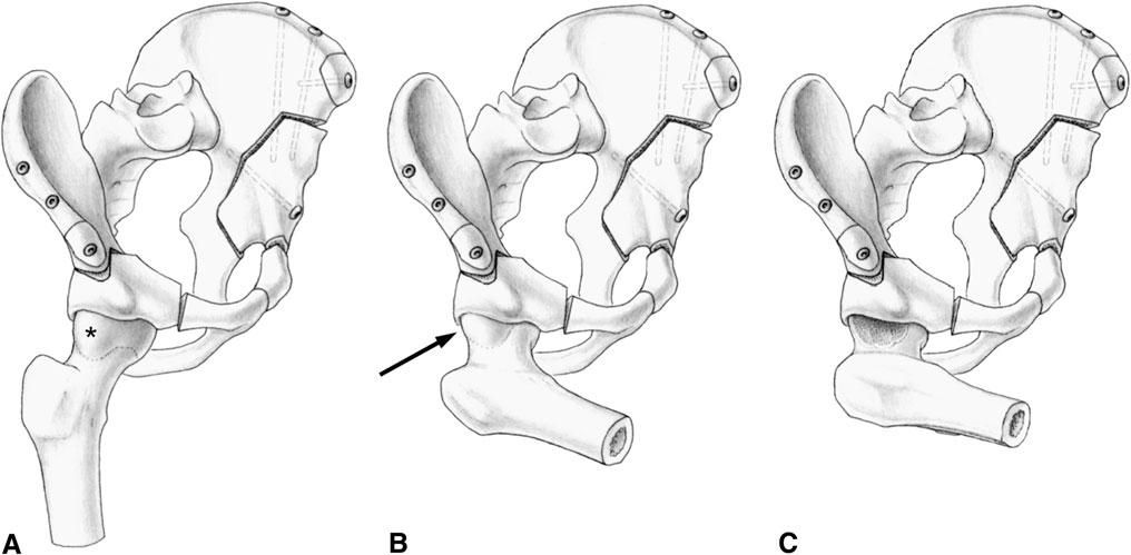 1604 Albers et al. Clinical Orthopaedics and Related Research 1 Fig. 1A C The current technique of periacetabular osteotomy is shown.