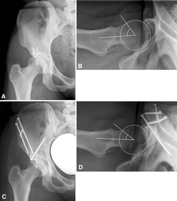 1610 Albers et al. Clinical Orthopaedics and Related Research 1 Fig. 4A D The radiographs of a 24-year-old woman from Group I (optimal acetabular retroversion and spherical femoral head) are shown.