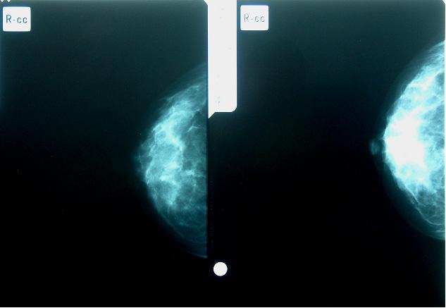 202 Mammography Recent Advances 2.09]) and 71%, respectively [1.56 1.87]), compared to never users (Aiello et al., 2006).