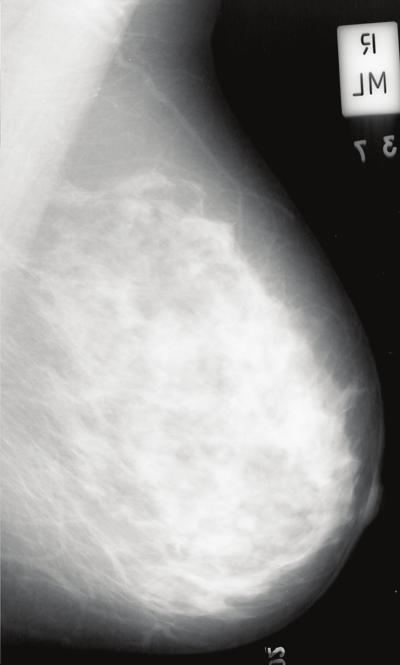 232 Mammography Recent Advances 16 Will-be-set-by-IN-TECH Fig. 7. Example mammographic segmentation. Tabár risk pattern IV; BIRADS risk pattern III.