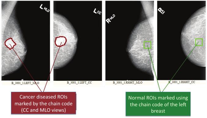 264 Mammography Recent Advances 4 Will-be-set-by-IN-TECH Fig. 1. Procedure applied for the selection of ROI s: images with malignant lesion and images no lesions.