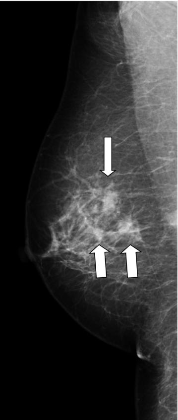 366 Mammography Recent Advances of DBT to