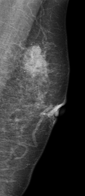 368 Mammography Recent Advances a.