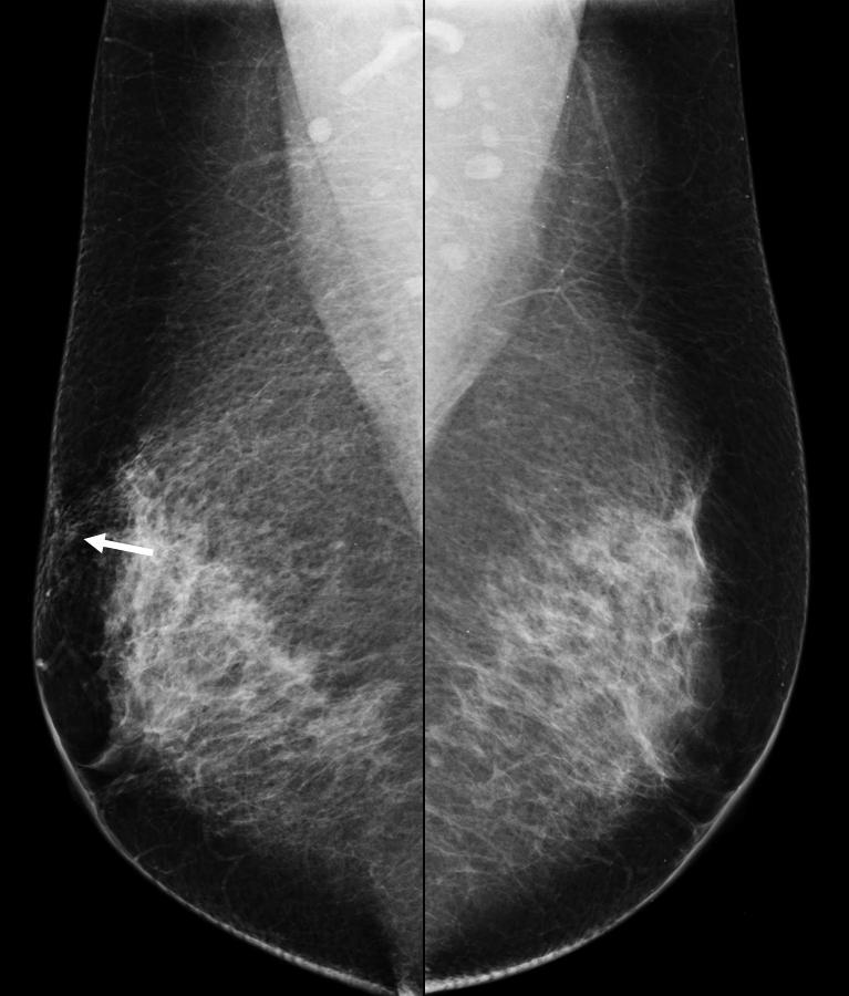 It is essential to obtain a thorough clinical history including possible trauma or surgery. 5. Imaging&pathological findings 5.1 Mammographic findings 5.1.1 Edema In many cases, edema does not manifest on the mammogram.