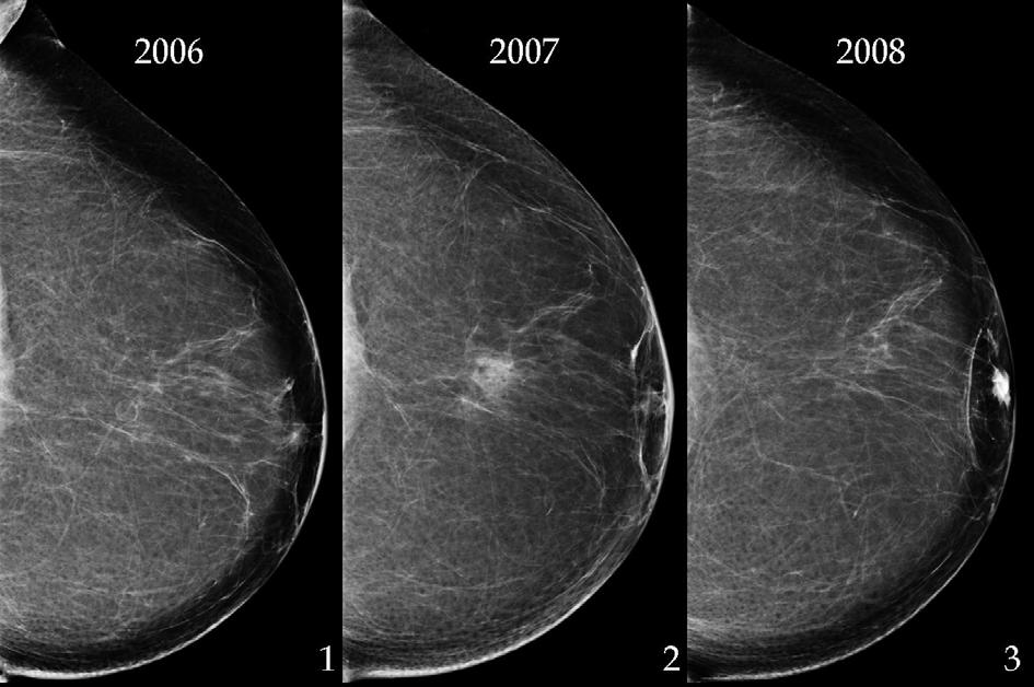 378 Mammography Recent Advances Fig. 6. Oil cyst (1). One year later, the patient had a reaction to a foreign body that simulated a malignant lesion (2). Core biopsy: fat necrosis.
