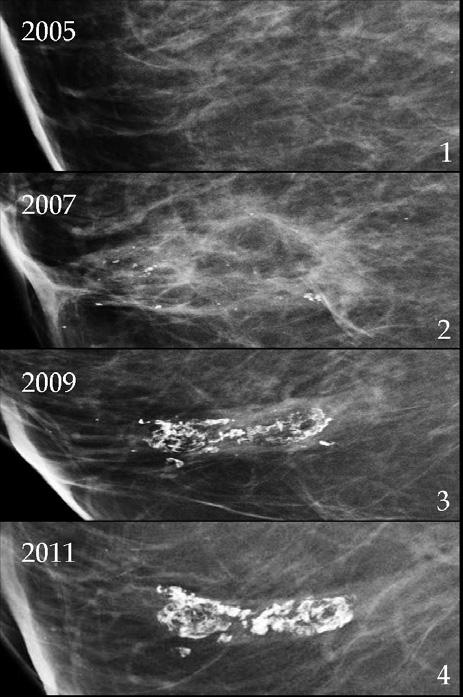 Fat Necrosis 379 5.1.5 Summary of the most common findings over time Fig. 8. Phases of fat necrosis: 1. Normal mammogram, with no history of trauma. 2. Retroareolar trauma in the left breast.
