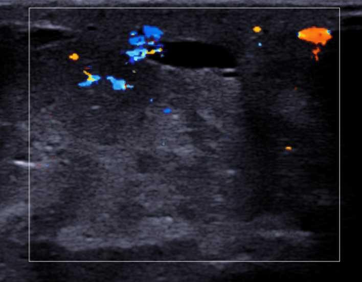 382 Mammography Recent Advances Fig. 13. Increased color Doppler signal reflects the increase in vascularization after trauma. 5.3.3 Oil cyst Oil cysts are round or oval anechoic lesions with smooth, well-defined, generally hyperechoic margins.