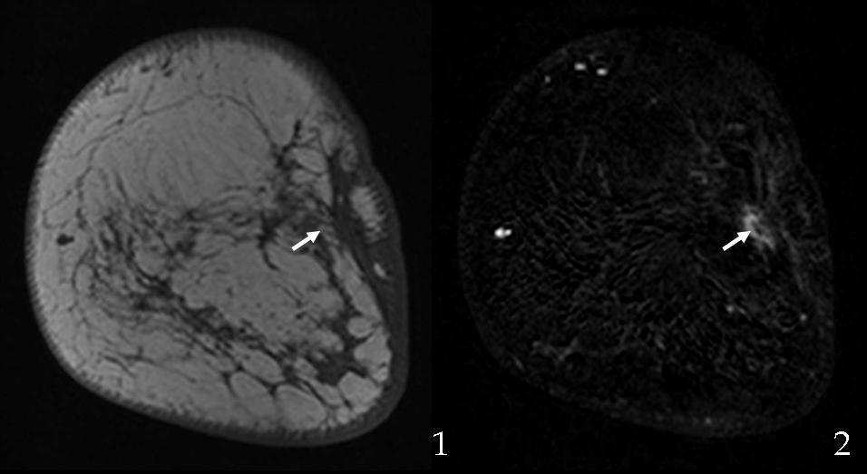 386 Mammography Recent Advances can cause enhancement of the scar. Hyperintense foci may also be seen within the scar in T1- weighterd sequences due to the persistence of fat (20). Fig. 20.