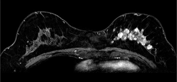 3B. Contrast enhanced T1 weighted image on early phase of HR-MRI; Segmental distribution of multiple nodular