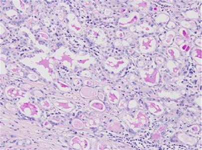The secretory material of the secretory carcinoma is positive for Periodic acid-schiff stain.