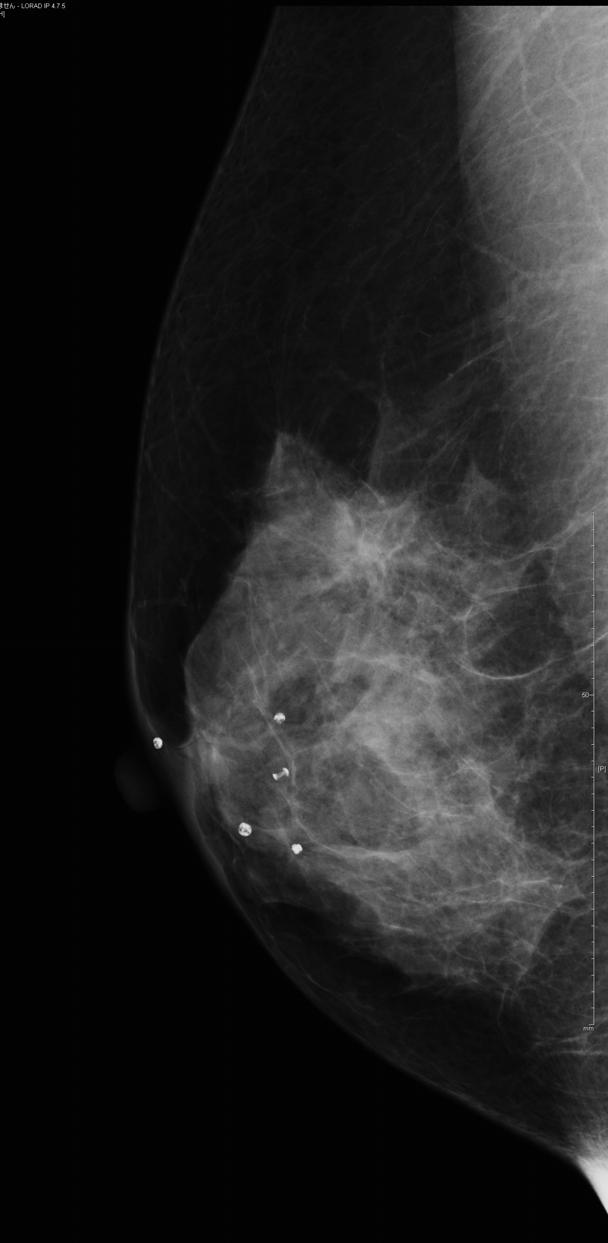 Radiologic Features of Triple Negative Breast Cancer 403 Findings Number (%) Calcifications 4 (20) Mass 2 (10) Focal asymmetric density 3 (15) Architectural destortion 5 (25) No abnormal findings 6