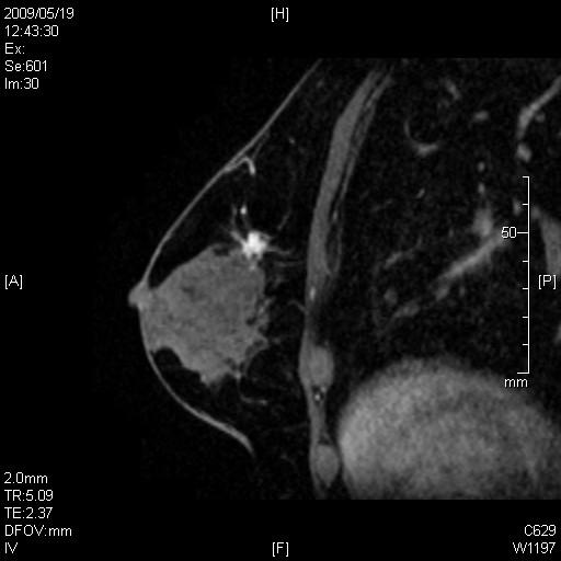 Radiologic Features of Triple Negative Breast Cancer 405 Fig. 1.4. A first representative caseof DCIS, MRI.