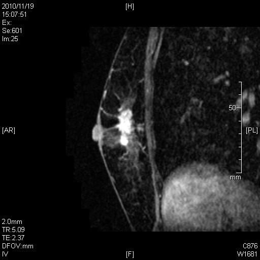 408 Mammography Recent Advances Fig. 2.3. A second representative case of DCIS, MRI. 3.2 IDC Table 4 shows the radiological findings of TN invasive cancer in our study.