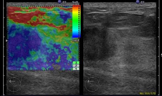 Radiologic Features of Triple Negative Breast Cancer 411 Fig. 3.3. A first representative case of IDC, Ultrasound; elastography. Fig. 3.4. A first representative case of IDC, MRI.