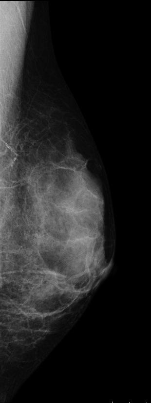 412 Mammography Recent
