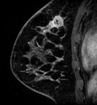 Radiologic Features of Triple Negative Breast Cancer 413 Fig. 4.3. A second representative case of IDC, MRI. 4. Discussion There are a few reports describing mammography and ultrasound findings of triplenegative breast cancers (Ko ES et al.