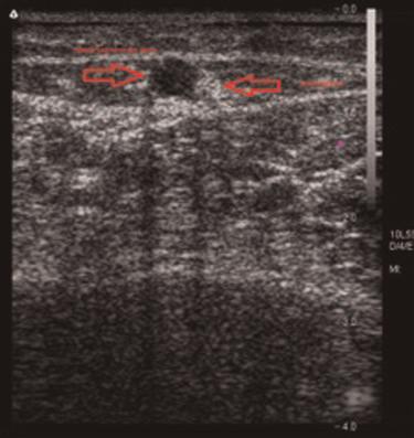 Review article D Dexter et al. Complications of endovenous lasers Figure 1 Duplex ultrasound of the small saphenous vein (SSV) and its proximity to the sural nerve junction.