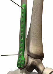 Plate Fixation Provisional Fixation Place the chosen ORTHOLOC 3Di Ankle Fracture plate on the bone, ensuring adequate points of fixation can be achieved on all sides of the fracture line/s. 1.