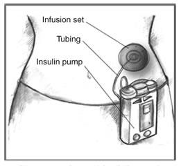from a vial. The user then removes the needle and plunger and loads the filled cartridge into the pump. Insulin pumps contain enough insulin for several days.